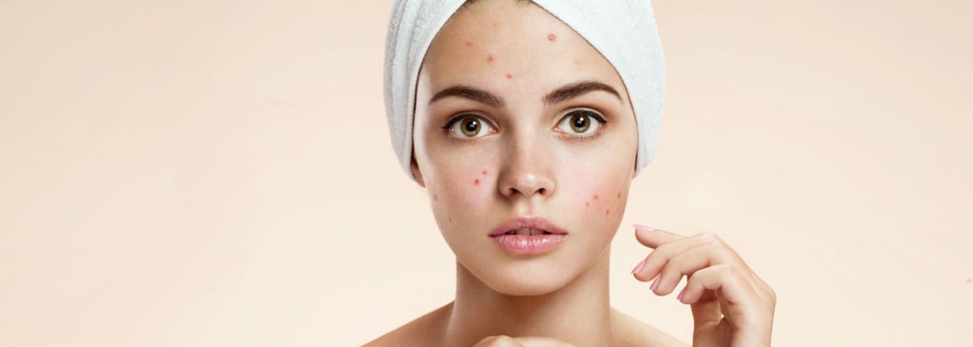 The Best Acne Skin Care Products for Adults and Teens - LaLa Daisy