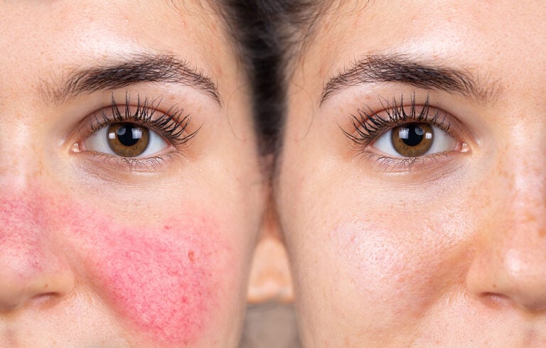 Best Rosacea Skin Care Regimen image