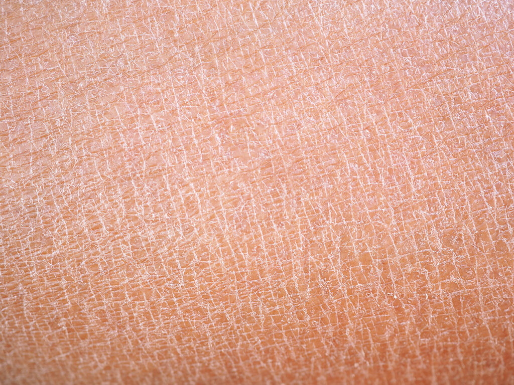 Beauty Blog dry skin or ichthyosis texture detail stock photo