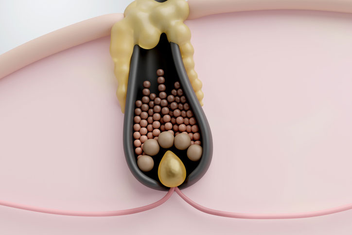 Beauty Blog Clogged hair follicle with sebum buildup and dirt blocking hair growth stock photo