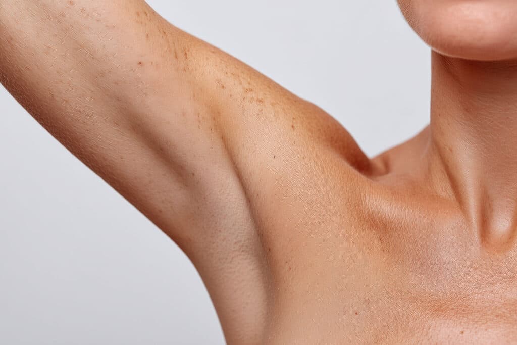 Beauty Blog Close up of underarm with clogged pores dark dots and uneven skin tone stock photo