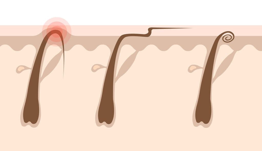 Beauty Blog Types of ingrown hairs flat illustration stock photo