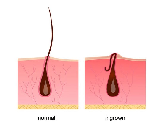 Beauty Blog Ingrown hair after shaving, cream or epilator. Anatomy infographics of hair stock photo