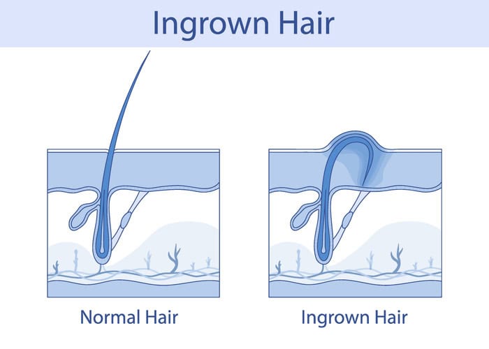 Beauty Blog Ingrown hair, hand-drawn anatomical illustration in cartoon style stock photo